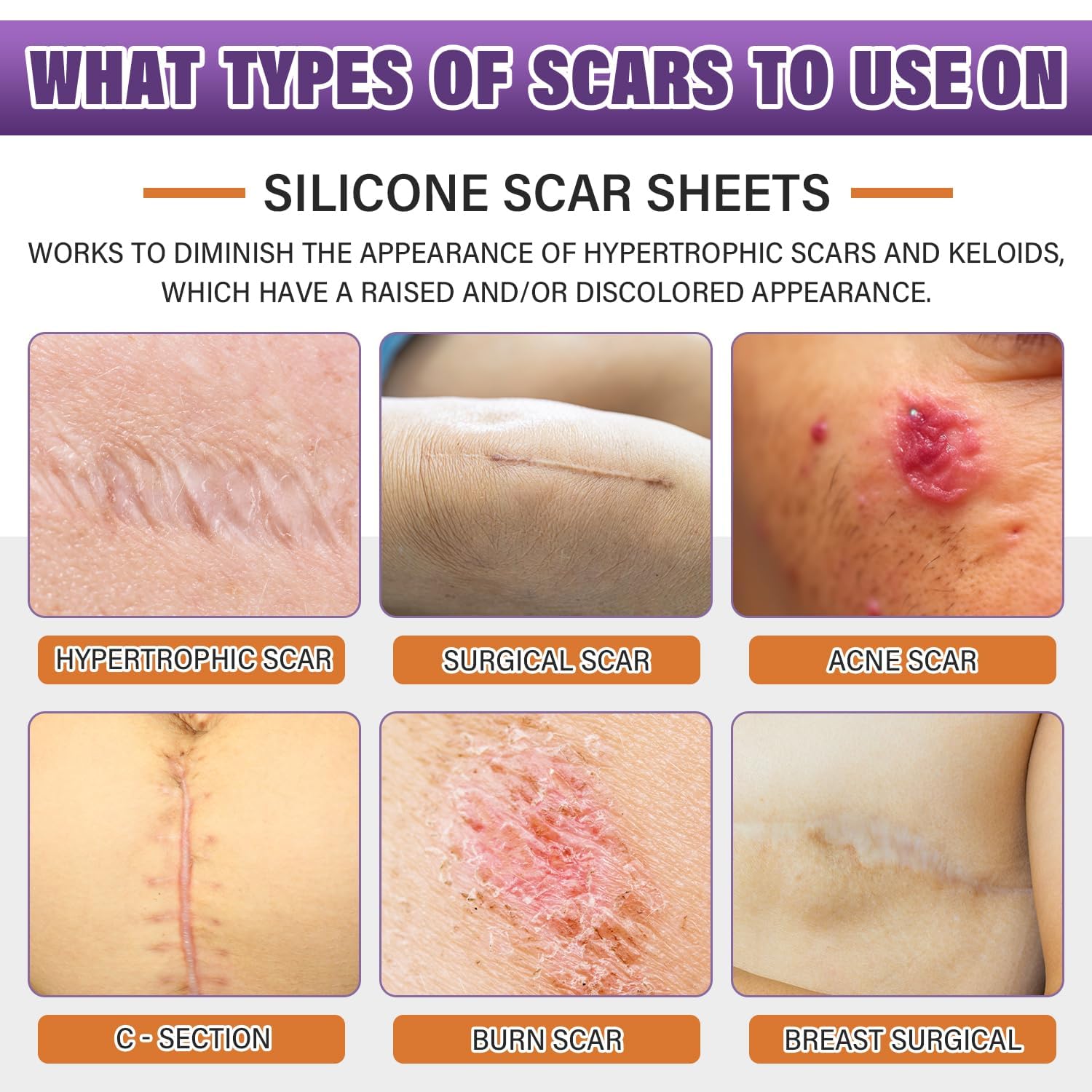 Silicone Scar Sheets Roll for Keloids and Post-Surgical Scars Supports Smoother Skin Appearance and Scar Texture Improvement - imprüv  